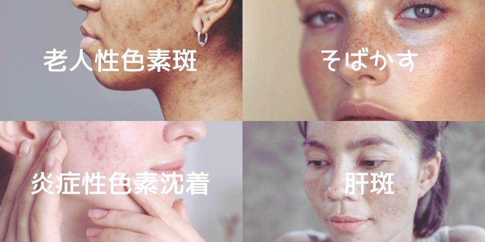 4種類のシミ