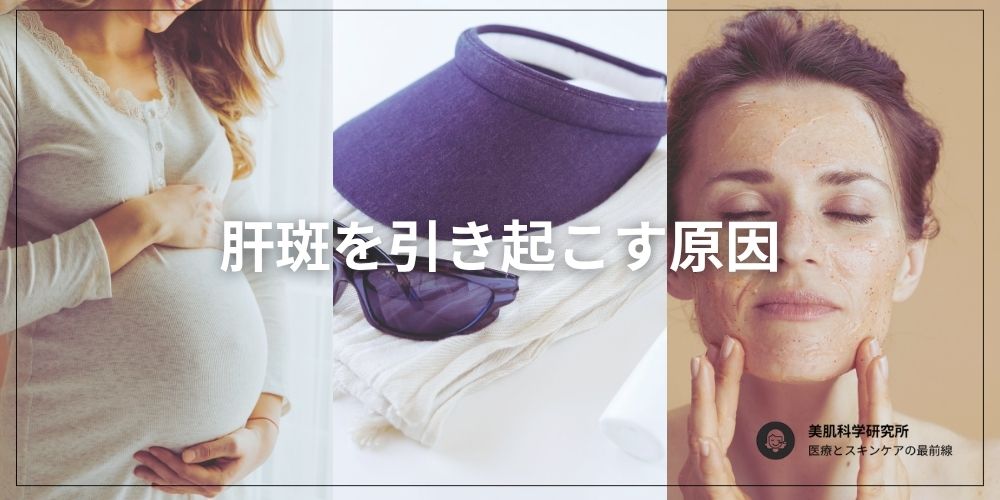 肝斑の引き金となる要因