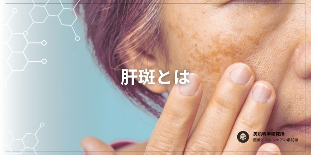 肝斑について