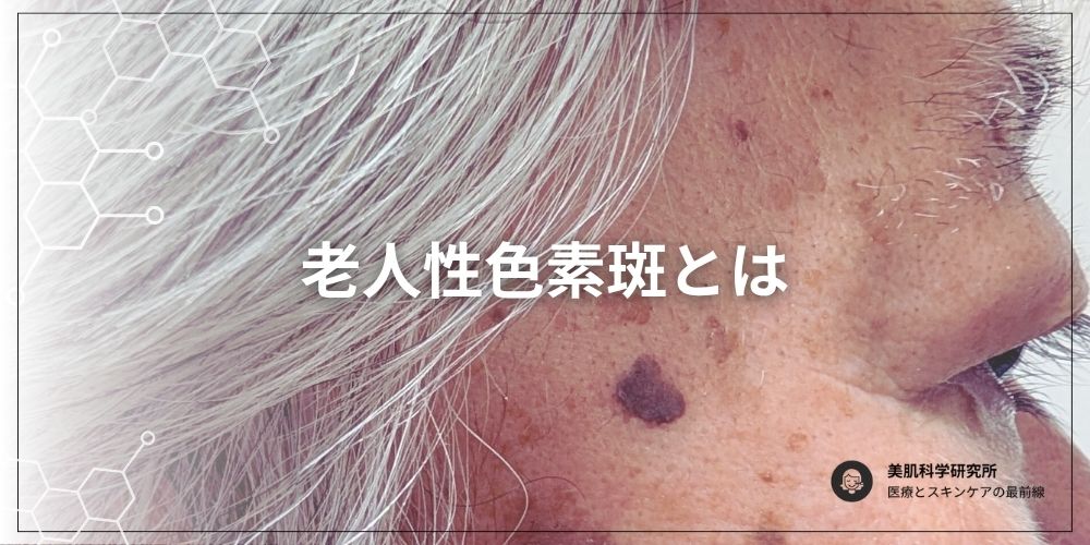 老人性色素斑について